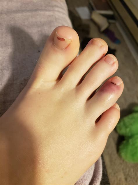 i stubbed my toe and it's purple